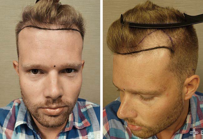 Vorher Saphir Haartransplantation mit 2800 Grafts bei Patient Alexander Kitzel