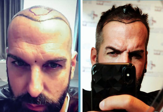 Vorher Saphir Haartransplantation mit 3400 Grafts bei Patient Jürgen T