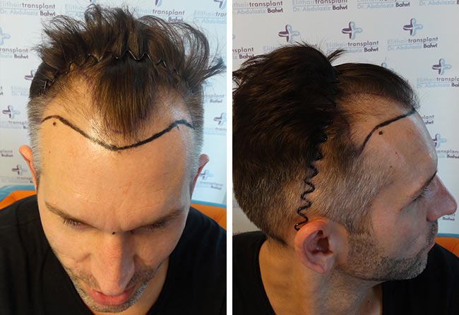 Vorher Saphir Haartransplantation mit 4250 Grafts bei Patient Thomas Schreier