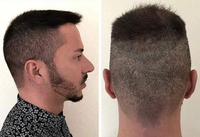 Nachher DHI Haartransplantation mit 5200 Grafts bei Patient Andre