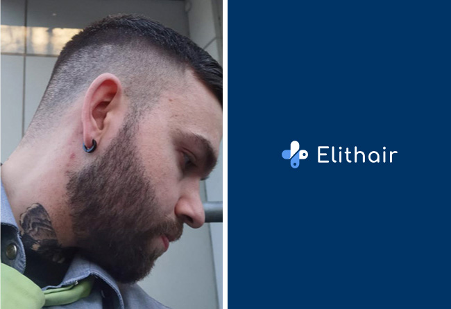 Nachher Saphir Barttransplantation mit 2700 Grafts bei Patient Nico