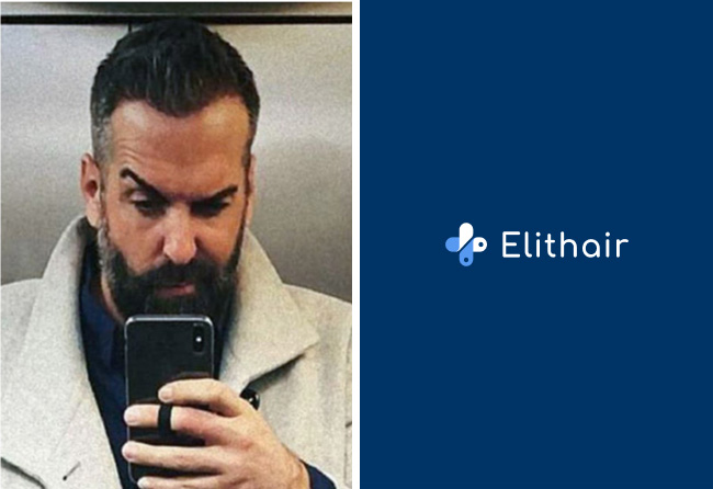 Ergebniss Nachher Saphir Haartransplantation mit 3400 Grafts bei Patient Jürgen