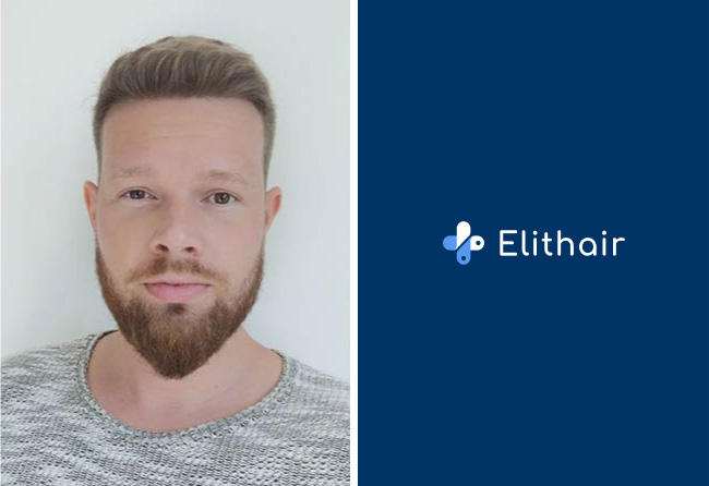 Nachher Saphir Haartransplantation mit 2800 Grafts bei Patient Alexander