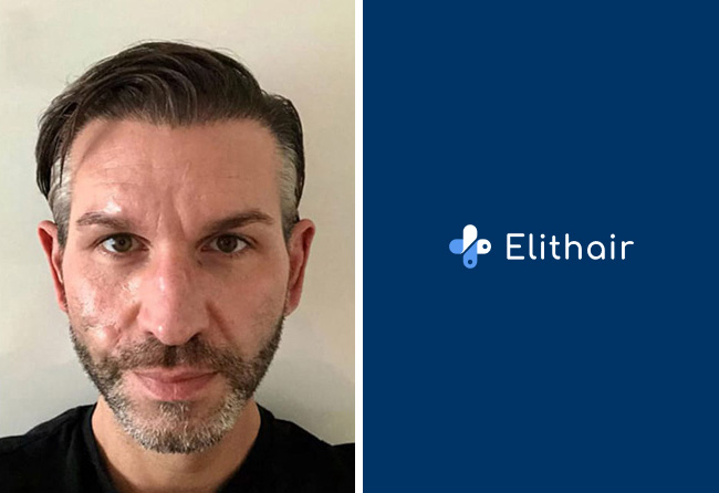 Nachher Saphir Haartransplantation mit 4250 Grafts bei Patient Thomas