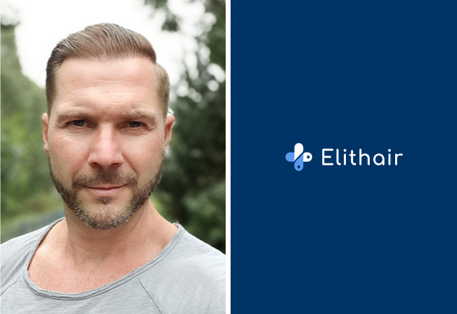 Nachher Saphir Haartransplantation mit 4100 Grafts bei Patient Markus