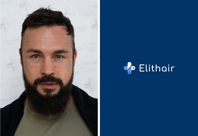 Nachher Saphir Haartransplantation mit 2900 Grafts bei Patient Road to Glory