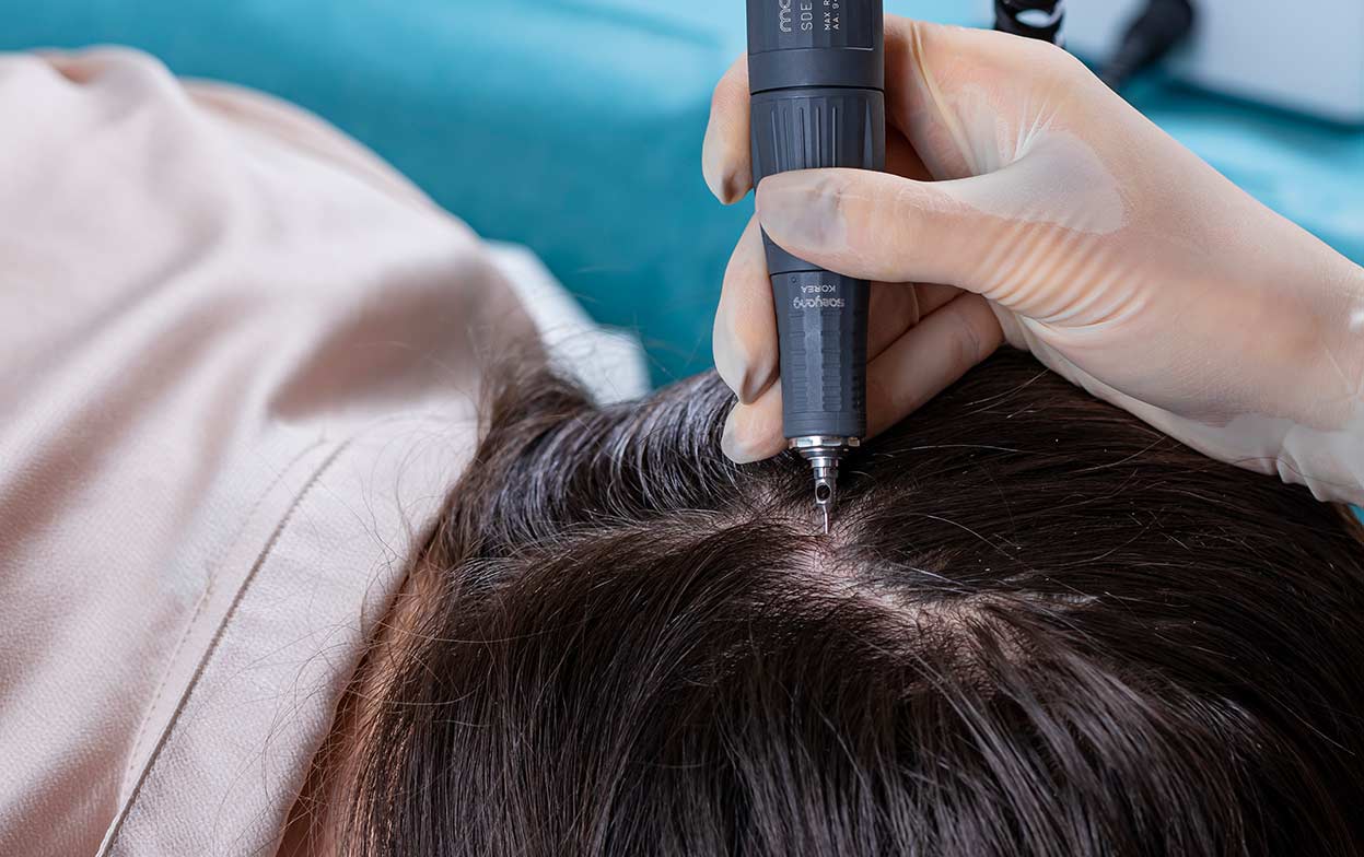 FUE Haartransplantation ohne Rasur bei einem Patienten