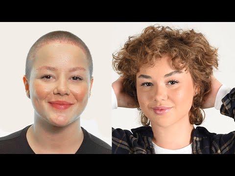 Thumbnail für die Augenbrauentransplantation Vorher Nachher Bilder bei Patientin