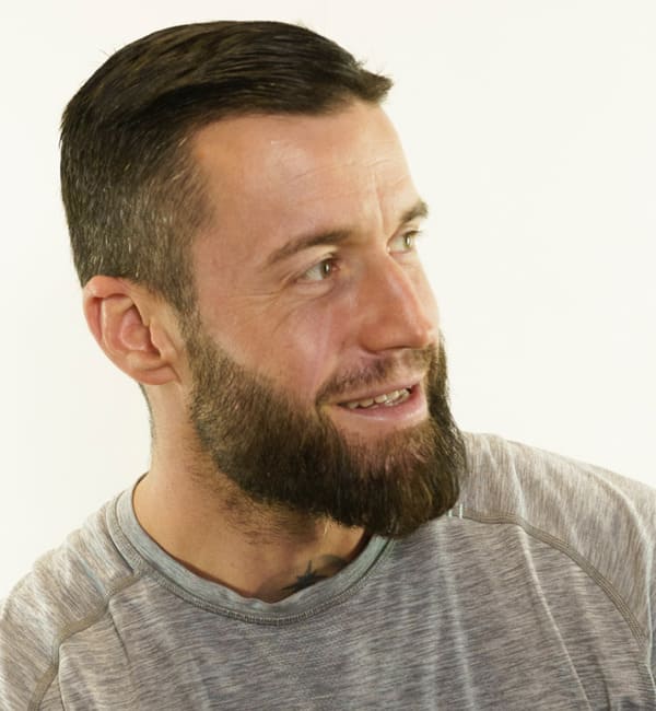 Patient Jhaki nach der Barttransplantation in Hamburg