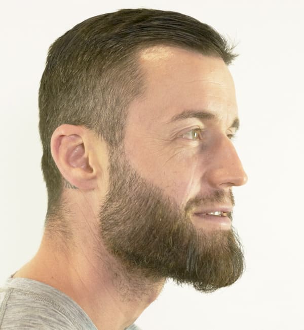 Patient Jhaki zufrieden nach der Barttransplantation in München