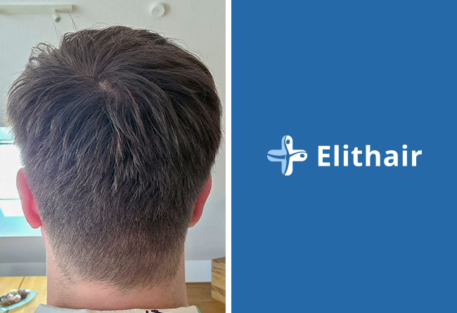 Spenderbereich 5 Monate nach Haartransplantation &ndash; Achim K., 2.000 Grafts