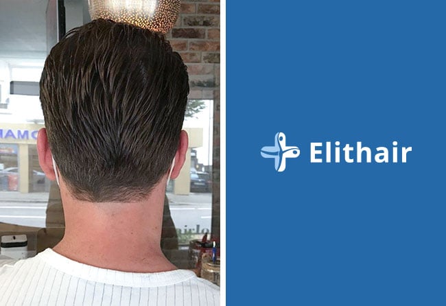 Spenderbereich Heilung 5 Monate &ndash; Cagatay T., 4.000 Grafts