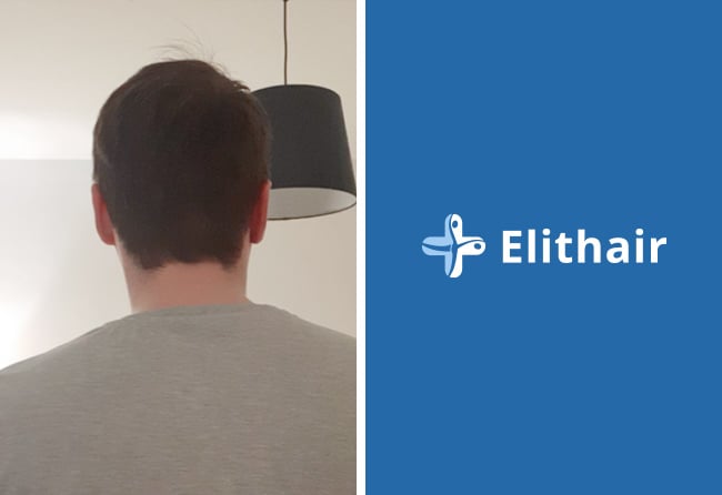 Spenderbereich 5 Monate nach Haartransplantation &ndash; Chris S., 3.500 Grafts