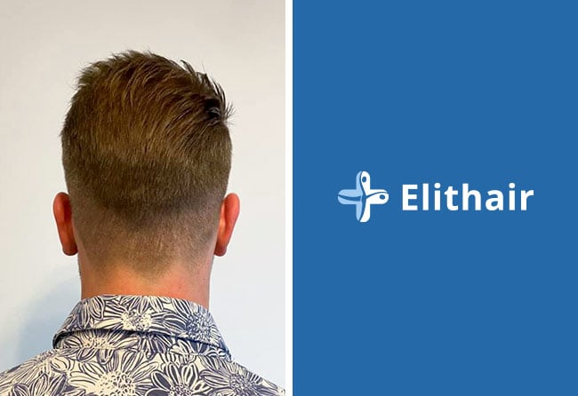 Spenderbereich 2 Monate nach Haartransplantation &ndash; Michael S., 4.700 Grafts