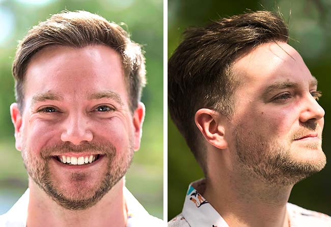 Nachher DHI Haartransplantation mit 2000 Grafts bei Patient Achim Klein