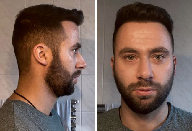 Nachher DHI Haartransplantation mit 3100 Grafts von Patient Ricardo Beier