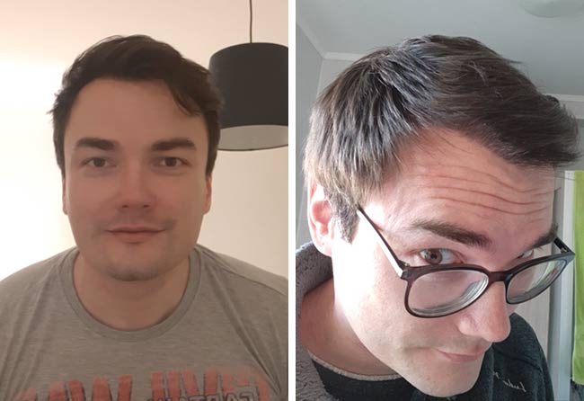 Nachher DHI Haartransplantation mit 3500 Grafts bei Patient Chris Scholz