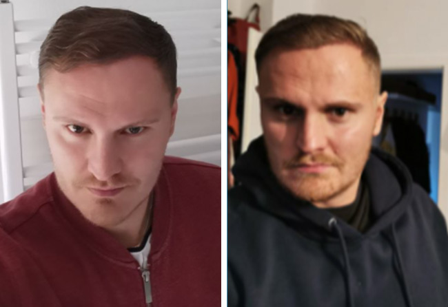 Nachher DHI Haartransplantation mit 3500 Grafts von Patient Tim Hoffmann