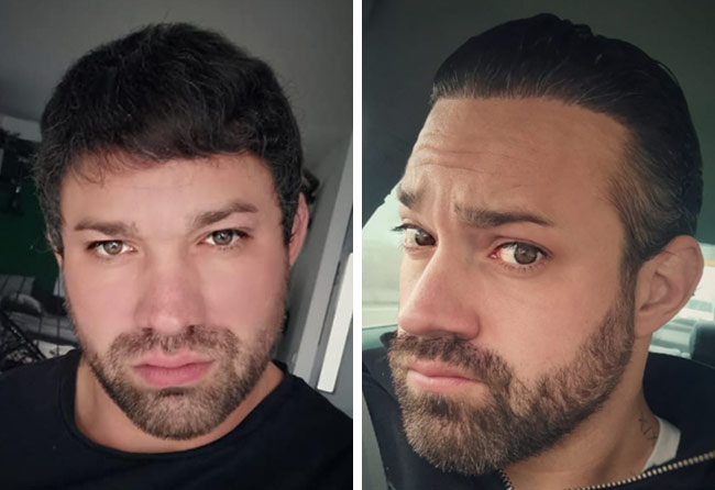 Nachher DHI Haartransplantation mit 3700 Grafts bei Patient Manuel Anderhuber