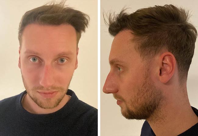 Nachher DHI Haartransplantation mit 3950 Grafts von Patient Oliver Dietrich