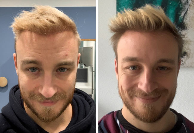 Nachher DHI Haartransplantation mit 4200 Grafts von Patient Marius Schmiddi