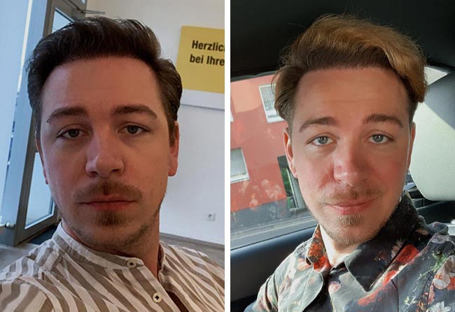 Nachher DHI Haartransplantation mit 4500 Grafts von Patient Tobias Plümacher