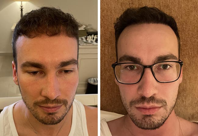 Nachher DHI Haartransplantation mit 4700 Grafts bei Patient Marcel Ploch