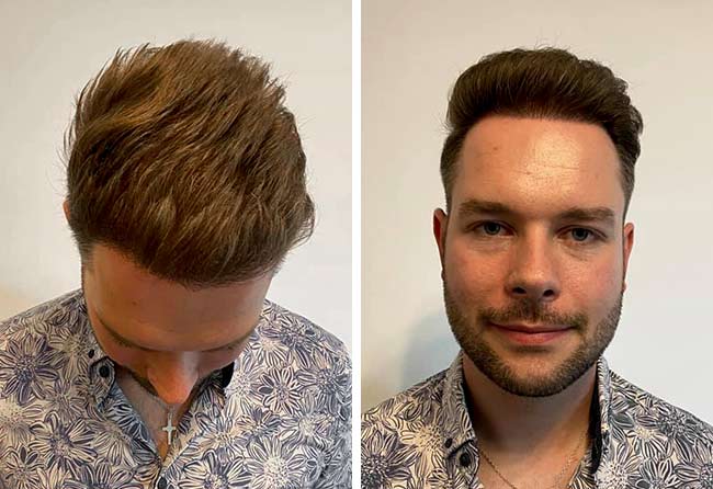 Nachher DHI Haartransplantation mit 4700 Grafts bei Patient Michael Simma