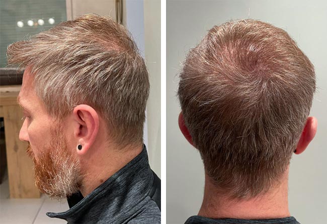 Nachher-dhi-haartransplantation-4750-grafts-Raffaele-Leucci