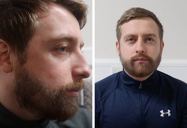 Nachher Saphir Barttransplantation mit 4200 Grafts bei Patient Jay Jones