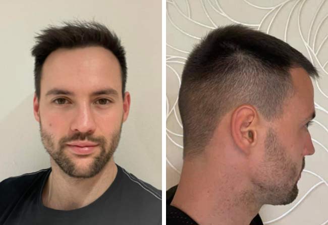 Nachher Saphir Haartransplantation mit 2700 Grafts bei Patient Alexander Volwerk