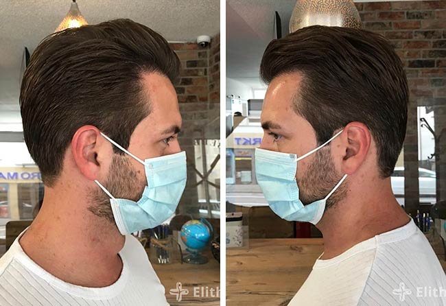 Nachher Saphir Haartransplantation mit 4000 Grafts bei Patient Cagatay Türkseven