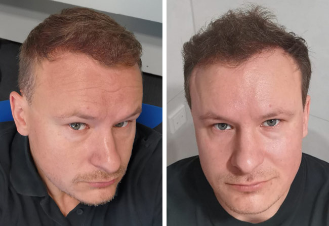Nachher Saphir Haartransplantation mit 4200 Grafts von Patient Sergej Weresomski