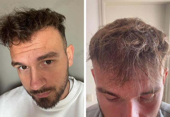 Nachher Saphir Haartransplantation mit 4500 Grafts von Patient Sefket Ahmetovic