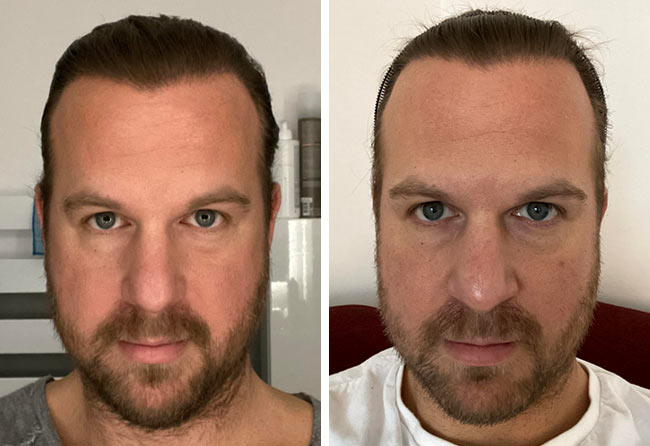 Nachher SDHI Haartransplantation mit 2700 Grafts von Patient Matthias Funk