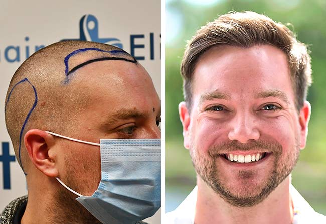 Vorher Nachher DHI Haartransplantation mit 2000 Grafts von Patient Achim Klein