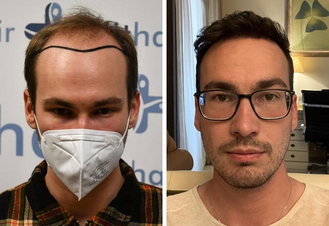 Vorher Nachher DHI Haartransplantation mit 4700 Grafts von Patient Marcel Ploch