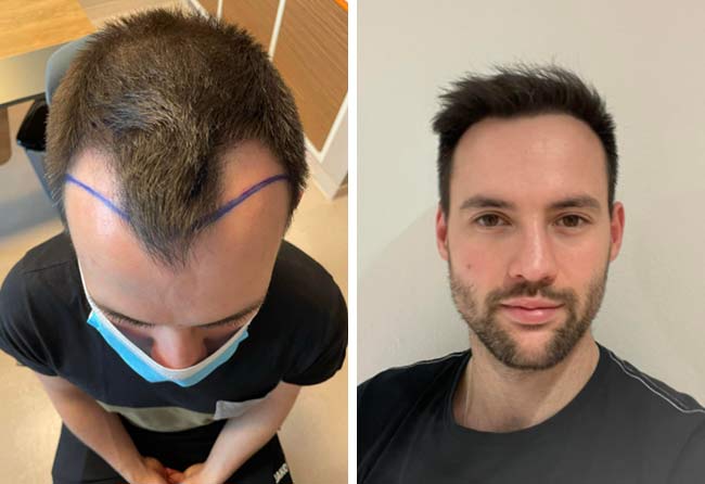 Vorher Nachher Saphir Haartransplantation mit 2700 Grafts von Patient Alexander Volwerk
