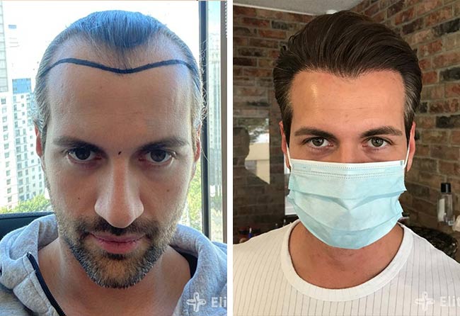 Vorher Nachher Saphir Haartransplantation mit 4000 Grafts von Patient Cagatay Türkseven