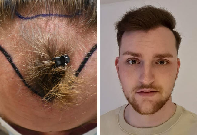 Vorher Nachher Saphir Haartransplantation mit 4200 Grafts von Patient Marc Stehr