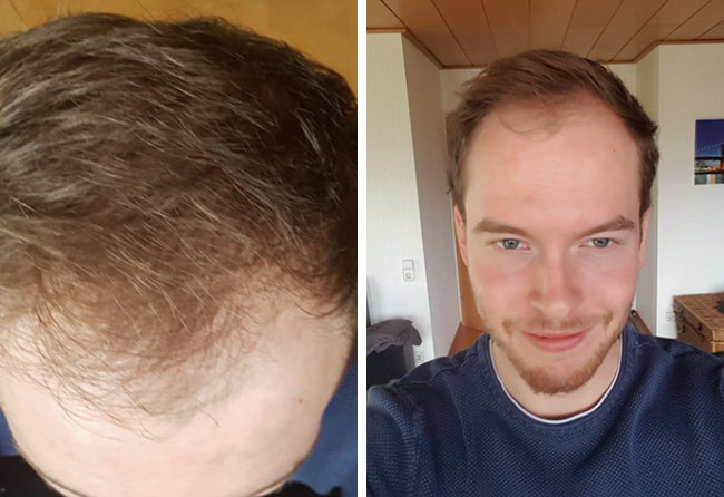 Vorher DHI Haartransplantation mit 3500 Grafts von Patient Lukas Jäger