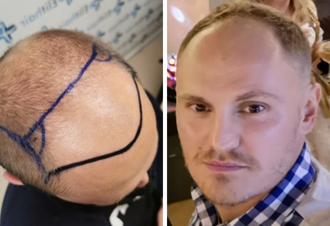 Vorher DHI Haartransplantation mit 3500 Grafts von Patient Tim Hoffmann