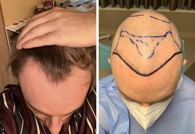 Vorher DHI Haartransplantation mit 4200 Grafts von Patient Marius Schmiddi