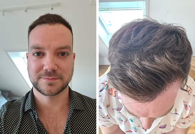 Vorher Nachher DHI Haartransplantation mit 2000 Grafts bei Patient Achim Klein nach 6 Monaten