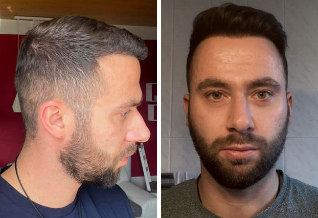 Vorher Nachher DHI Haartransplantation mit 3100 Grafts von Patient Ricardo Beier nach 4 Monaten