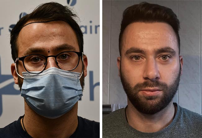 Vorher Nachher DHI Haartransplantation mit 3100 Grafts von Patient Ricardo Beier