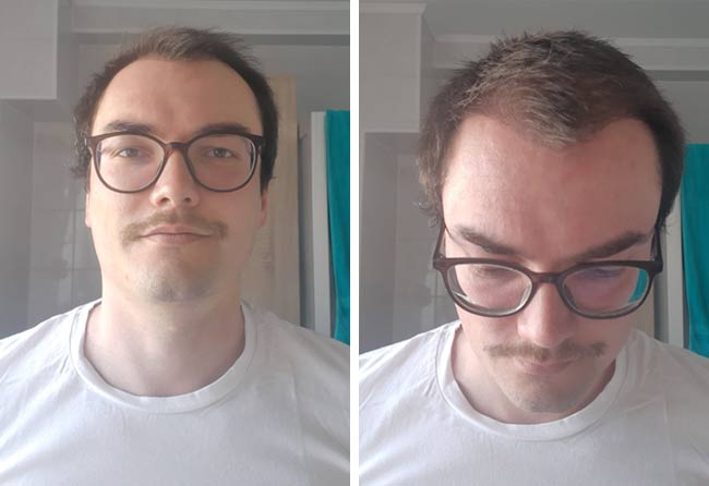 Vorher nachher DHI Haartransplantation mit 3500 Grafts bei Patient Chris Scholz nach 3 Monaten