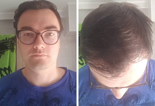 Vorher nachher DHI Haartransplantation mit 3500 Grafts bei Patient Chris Scholz nach 5 Monaten