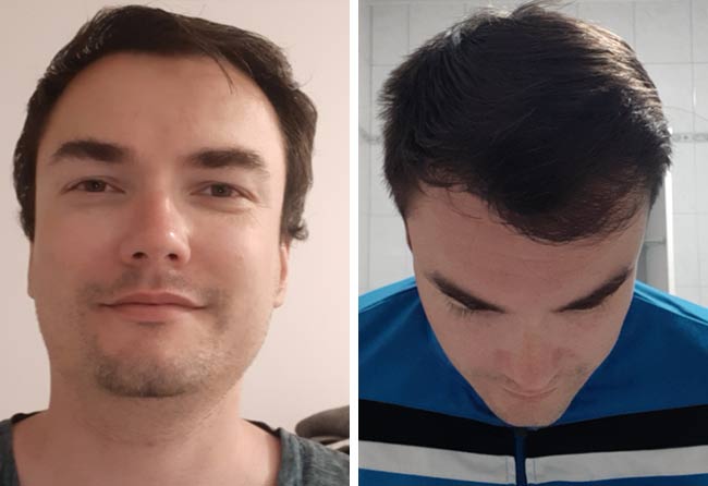 Vorher nachher DHI Haartransplantation mit 3500 Grafts bei Patient Chris Scholz nach 7 Monaten