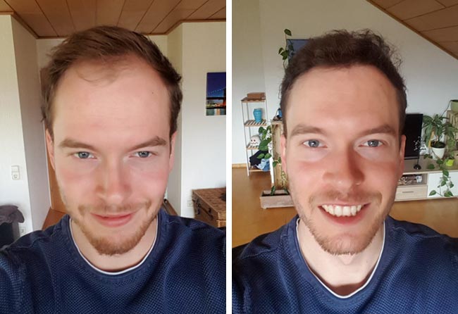 Vorher Nachher DHI Haartransplantation mit 3500 Grafts von Patient Lukas Jäger